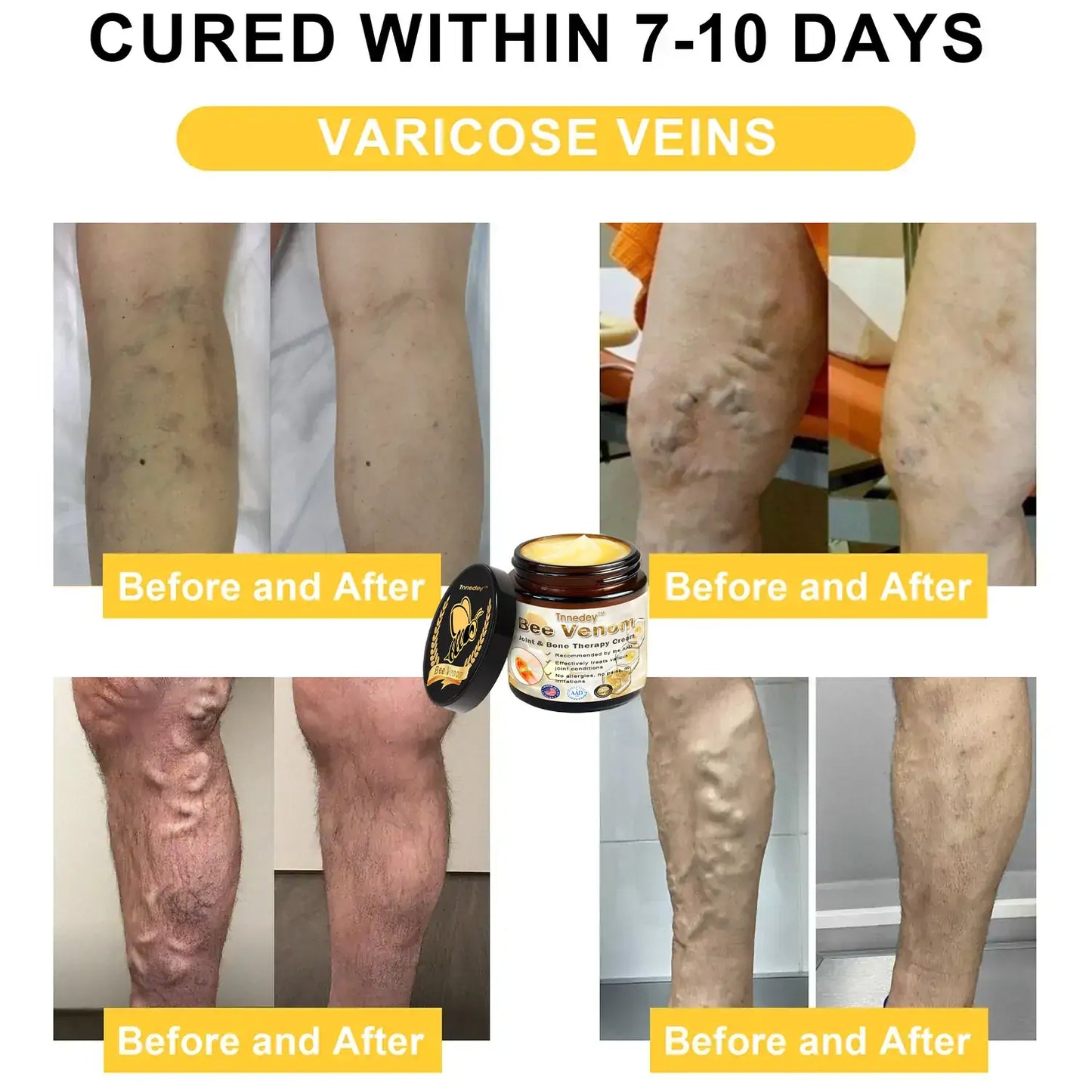 Bee Venom Arthritis Therapy Cream(𝐒𝐩𝐞𝐜𝐢𝐚𝐥𝐢𝐳𝐢𝐧𝐠 𝐢𝐧 𝐨𝐫𝐭𝐡𝐨𝐩𝐞𝐝𝐢𝐜 𝐜𝐨𝐧𝐝𝐢𝐭𝐢𝐨𝐧𝐬 𝐚𝐧𝐝 𝐣𝐨𝐢𝐧𝐭 𝐩𝐚𝐢𝐧 & AAOS recommends)