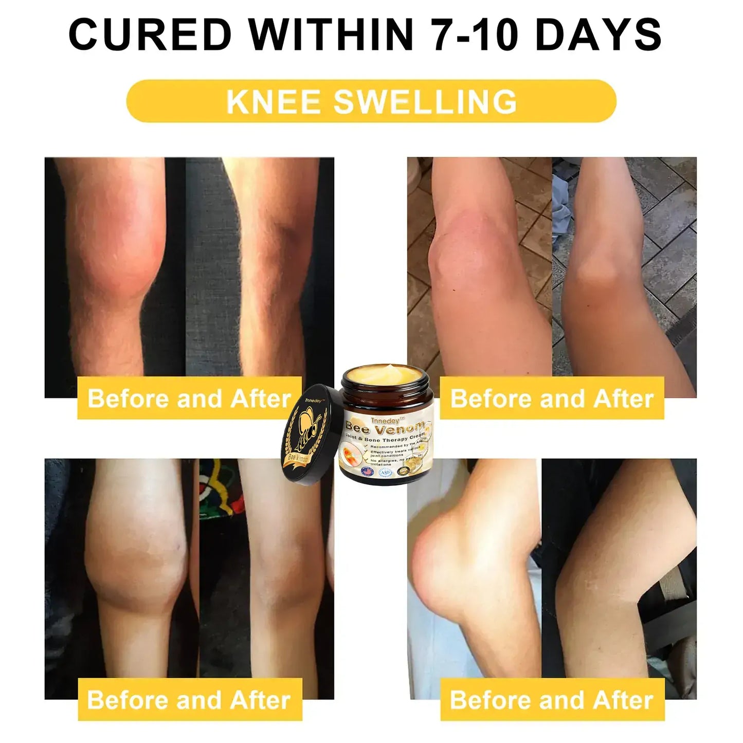 Bee Venom Arthritis Therapy Cream(𝐒𝐩𝐞𝐜𝐢𝐚𝐥𝐢𝐳𝐢𝐧𝐠 𝐢𝐧 𝐨𝐫𝐭𝐡𝐨𝐩𝐞𝐝𝐢𝐜 𝐜𝐨𝐧𝐝𝐢𝐭𝐢𝐨𝐧𝐬 𝐚𝐧𝐝 𝐣𝐨𝐢𝐧𝐭 𝐩𝐚𝐢𝐧 & AAOS recommends)
